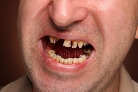 Żółte lub/i niekompletne zęby