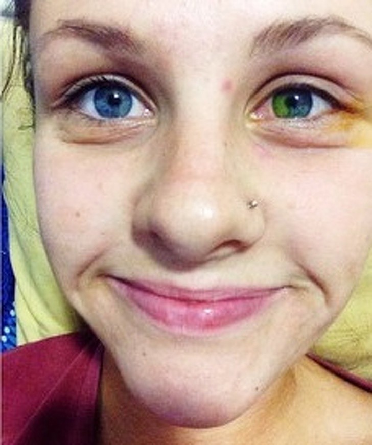 „W wyniku oparzenia, tęczówka w oku mojej przyjaciółki zmieniła kolor”