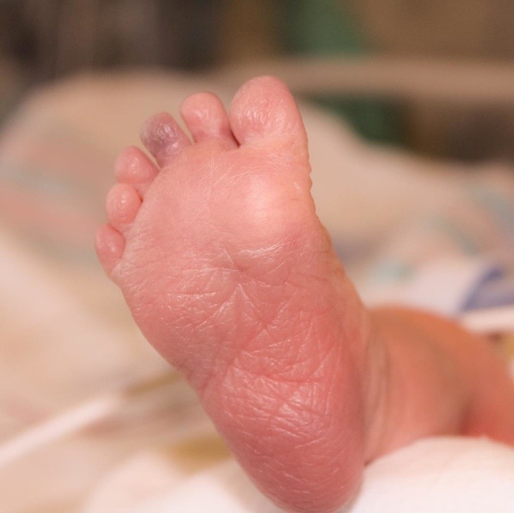 5. Ten niemowlak przyszedł na świat z 12 palcami u stóp.