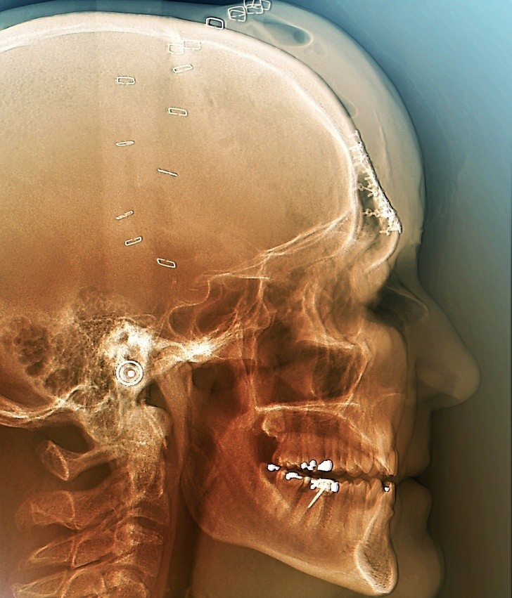 15. Zdjęcie wykonane po operacji mającej na celu zrekonstruowanie czaszki ofiary wypadku samochodowego