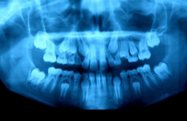2. Szczęka 10-letniego chłopca, którego zęby mleczne są zastępowane przez stałe