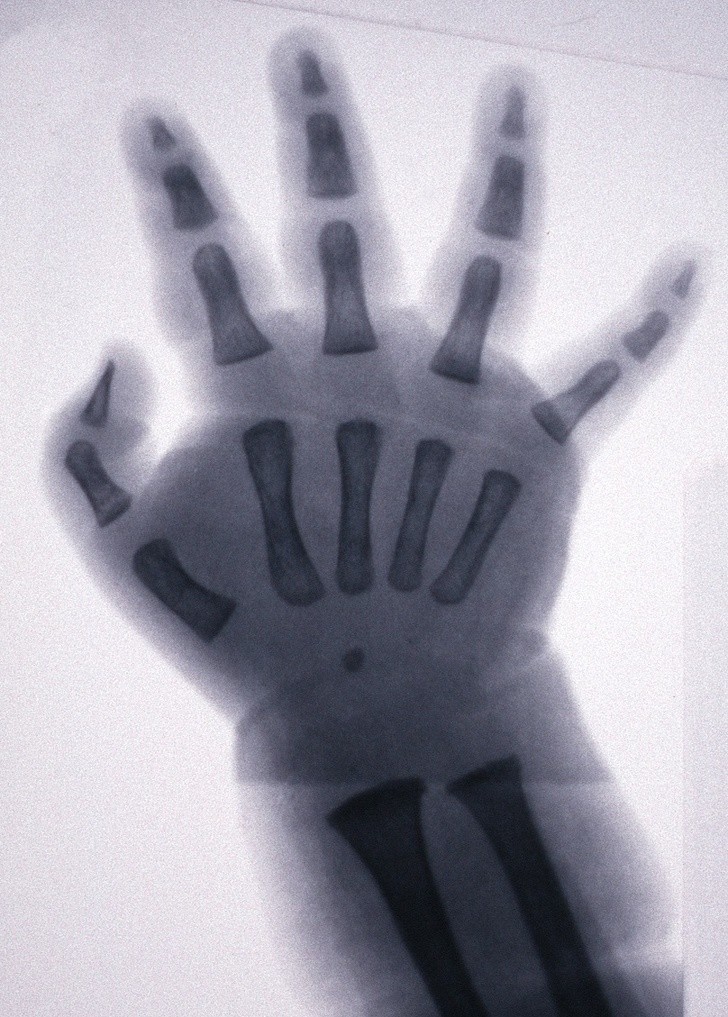 7. Prześwietlenie dłoni dziecka, która, w przeciwieństwie do osób dorosłych, posiada chrząstki zamiast kości