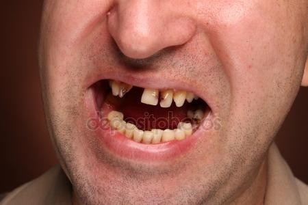 3. Żółte lub/i niekompletne zęby