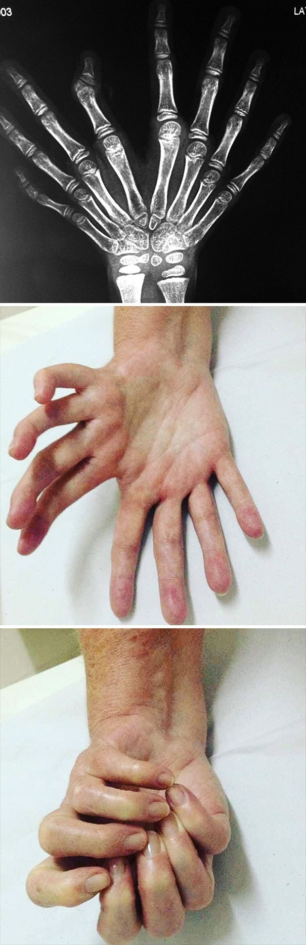 Bardzo rzadka wada wrodzona znana jako "lustrzana dłoń."