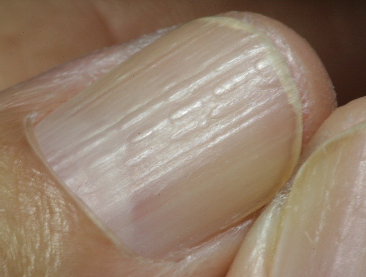 8. Pionowe wgłębienia na powierzchni paznokcia