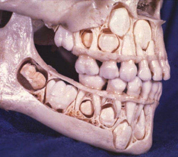 Teraz wiemy gdzie przed wyrośnięciem znajdują się zęby stałe.