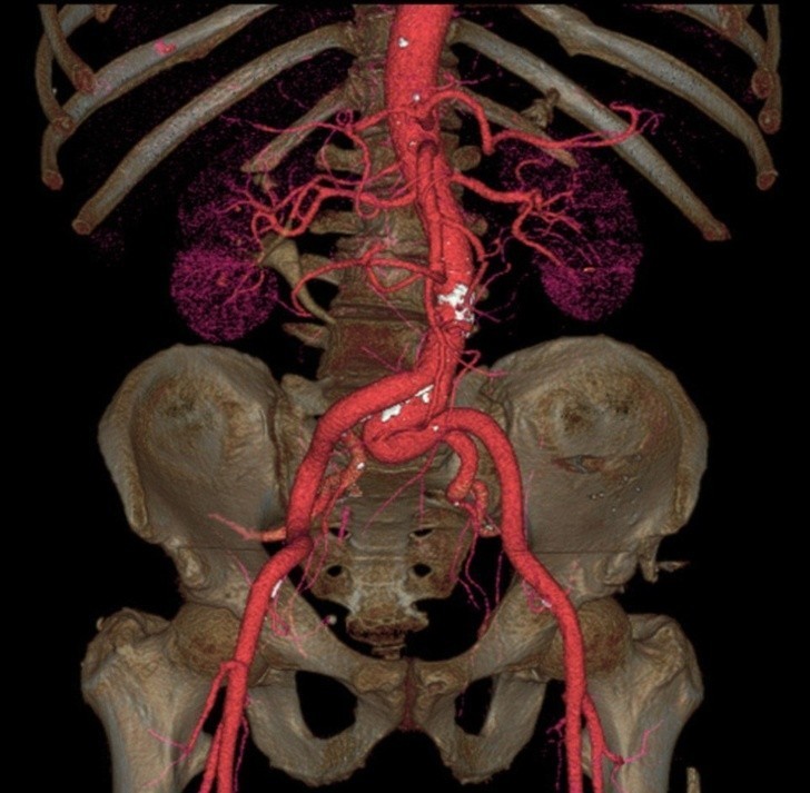 Aorta to największa arteria w naszym ciele