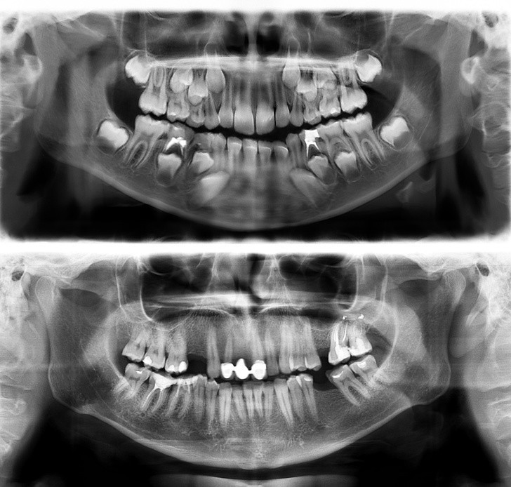 Porównanie zębów 7-latka (na górze) i 30-latka