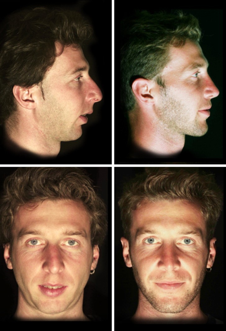 Rezultat operacji nosa i podbródka, a także liftingu twarzy