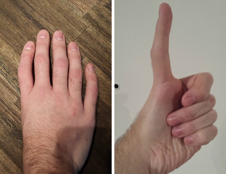 2. Trójpaliczkowy kciuk posiada – jak sama nazwa wskazuje – dodatkowy paliczek, przez co przypomina pozostałe palce.