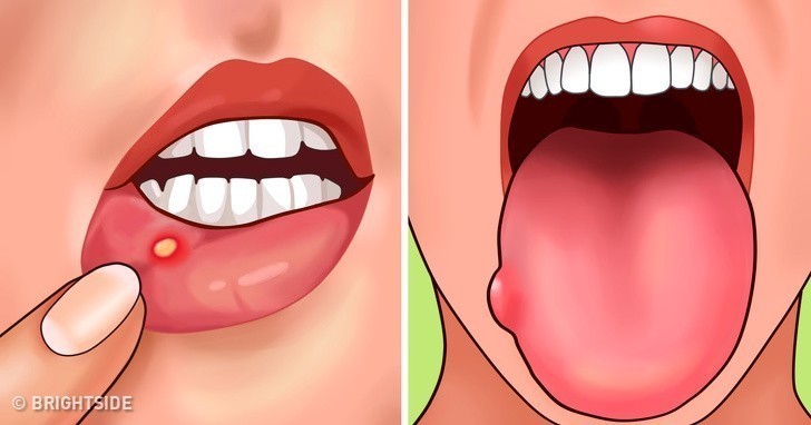 6. Afty w jamie ustnej i opuchlizna języka