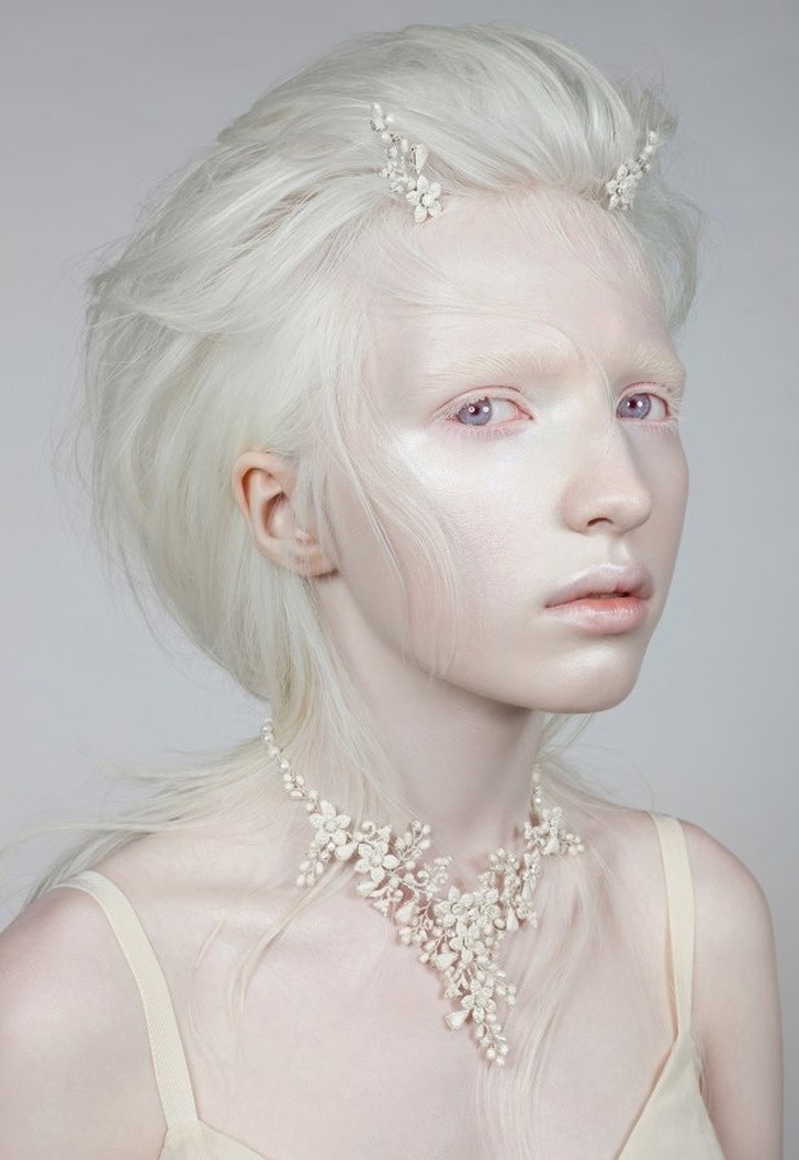 1. Albinizm