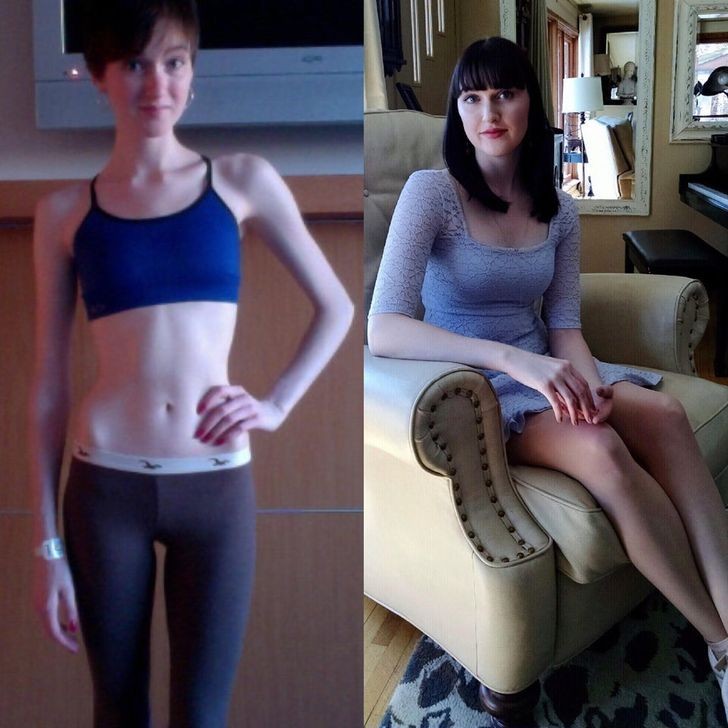 "Wygrałam 8-letnią walkę z anoreksją."