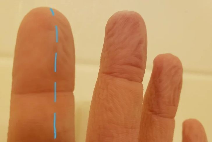 2. Efekt uszkodzonych nerwów w palcu wskazującym
