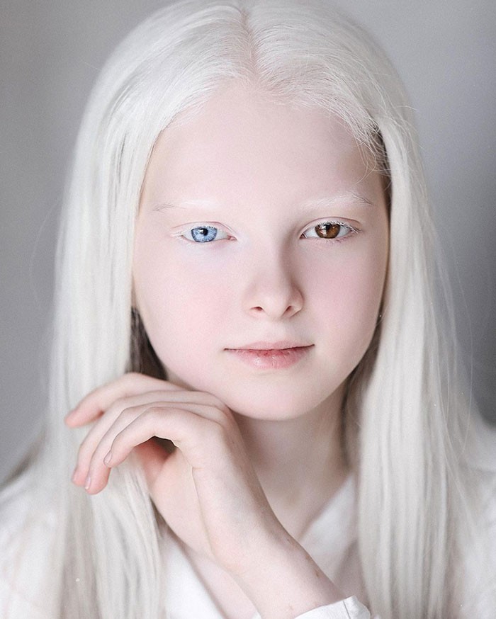 Amina Ependieva jest posiadaczką dwóch różnych zaburzeń - albinizmu i różnobarwności tęczówek.