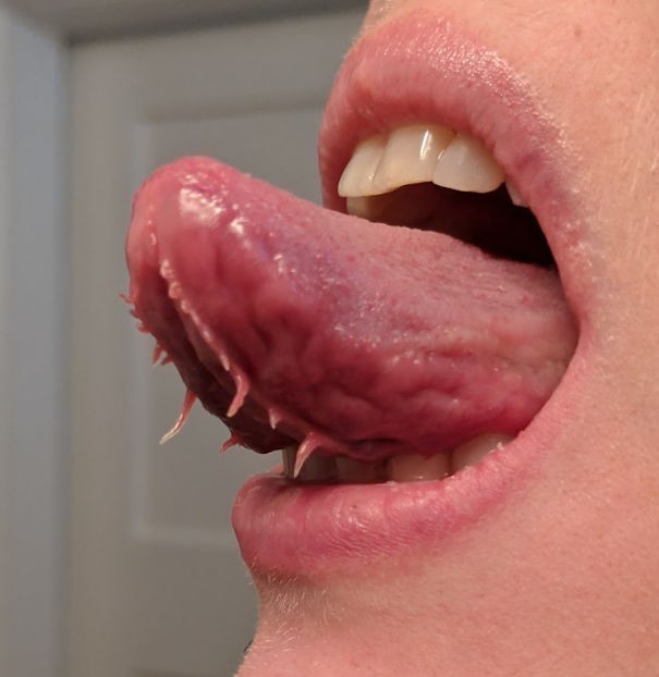 13. Po liežuviu turiu „čiuptuvus“.  Tikriausiai tai nėra labai dažna liga?