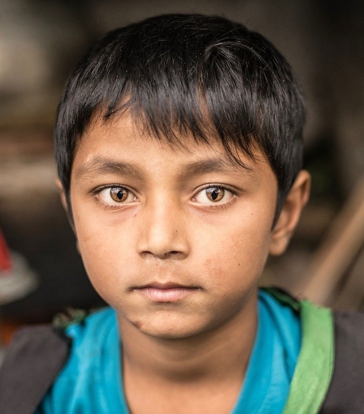 16. Ten chłopiec z Nepalu cierpi na zespół kociego oka