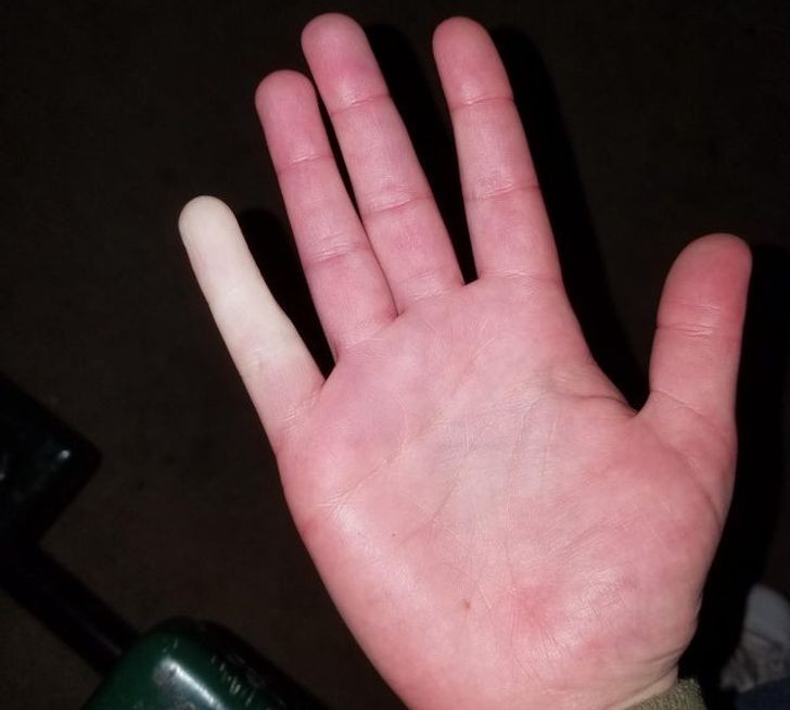Cierpię na objaw Raynauda - czasem, gdy jest zimno, moje palce wyglądają tak."