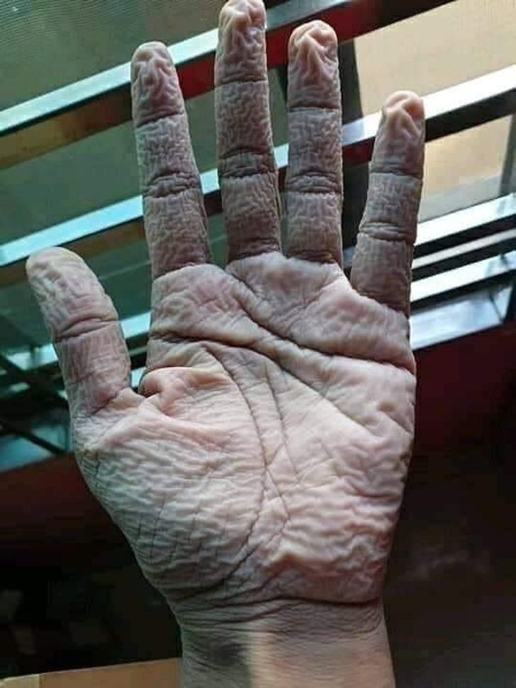 2. Ręka lekarza po zdjęciu rękawiczek na koniec 10-godzinnej zmiany