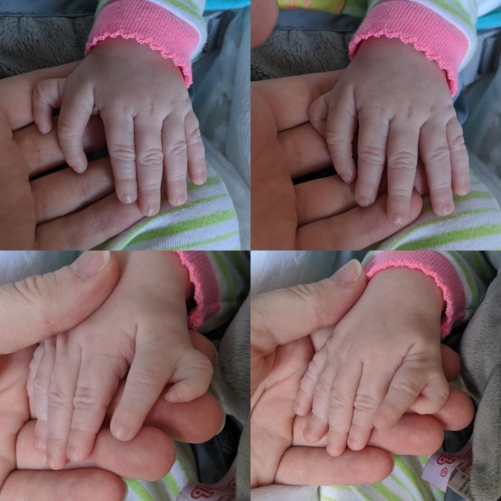 "Moja najmłodsza córka urodziła się z dodatkowym palcem u obu dłoni."