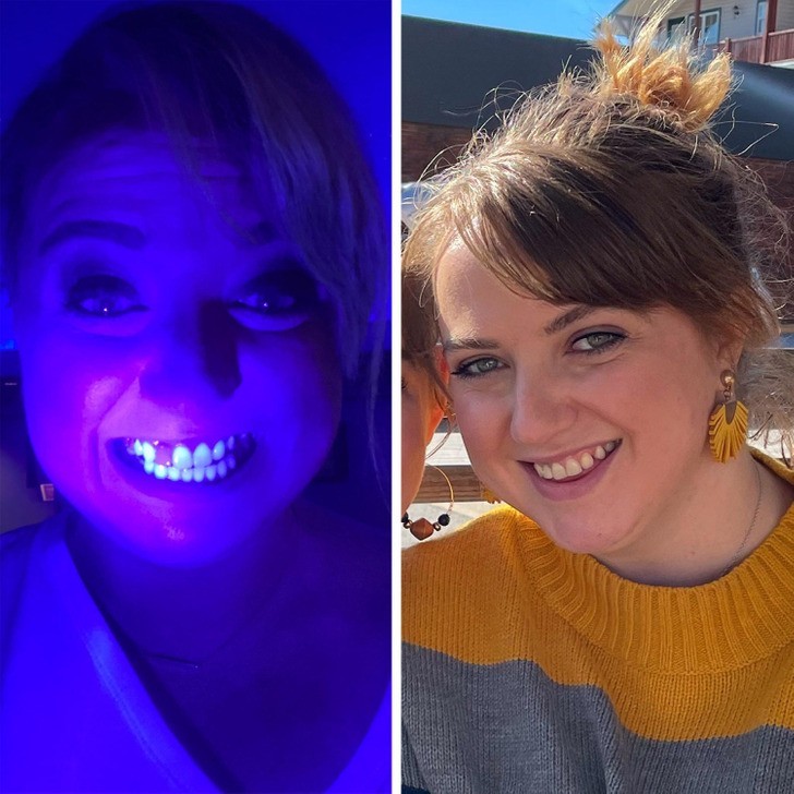 "Odkryłam, że mój implant nie świeci pod światłem UV jak pozostałe zęby."