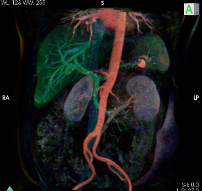 6. Aorta widoczna na rezonansie magnetycznym w kolorze