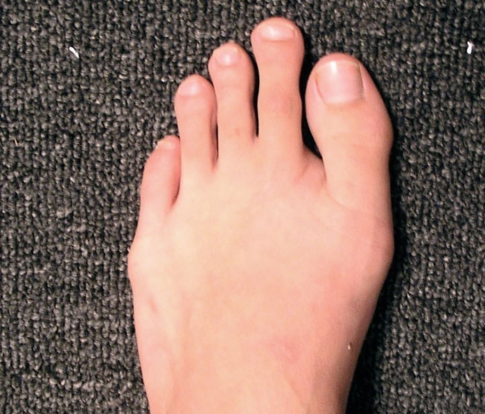 10. U 10% osób paluch stopy jest krótszy od reszty palców.