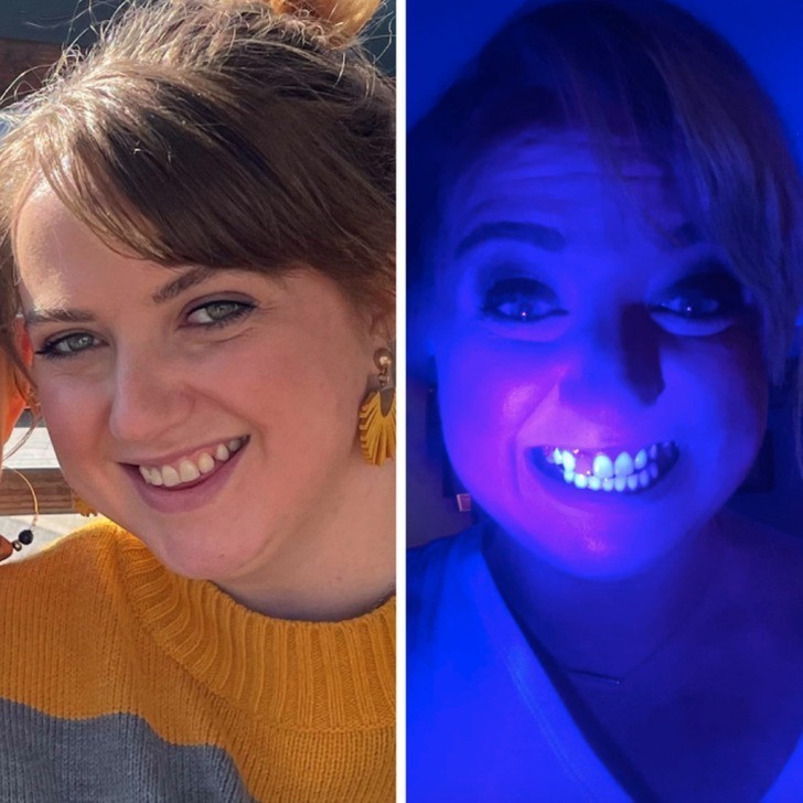 "Odkryłam, że mój implant nie świeci pod ultrafioletem, jak reszta moich zębów."