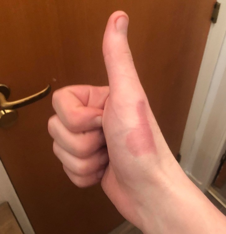 "Mam na kciuku oparzenie w kształcie uniesionego kciuka."