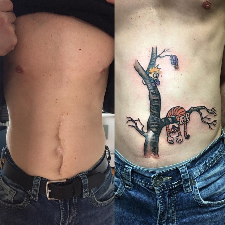"Zakryłem bliznę pooperacyjną tatuażem bohaterów kreskówki Calvin i Hobbes."