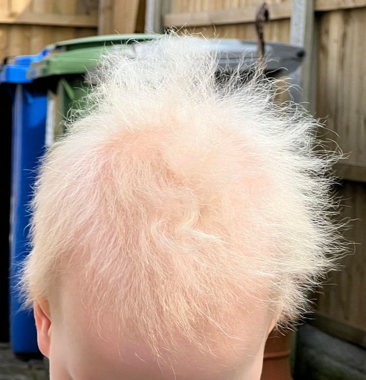 "Mój syn ma dolegliwość znaną jako zespół włosów nienadających się uczesać. Sprawia ona, że jego włosy są niezwykle miękkie, białe i cienkie."