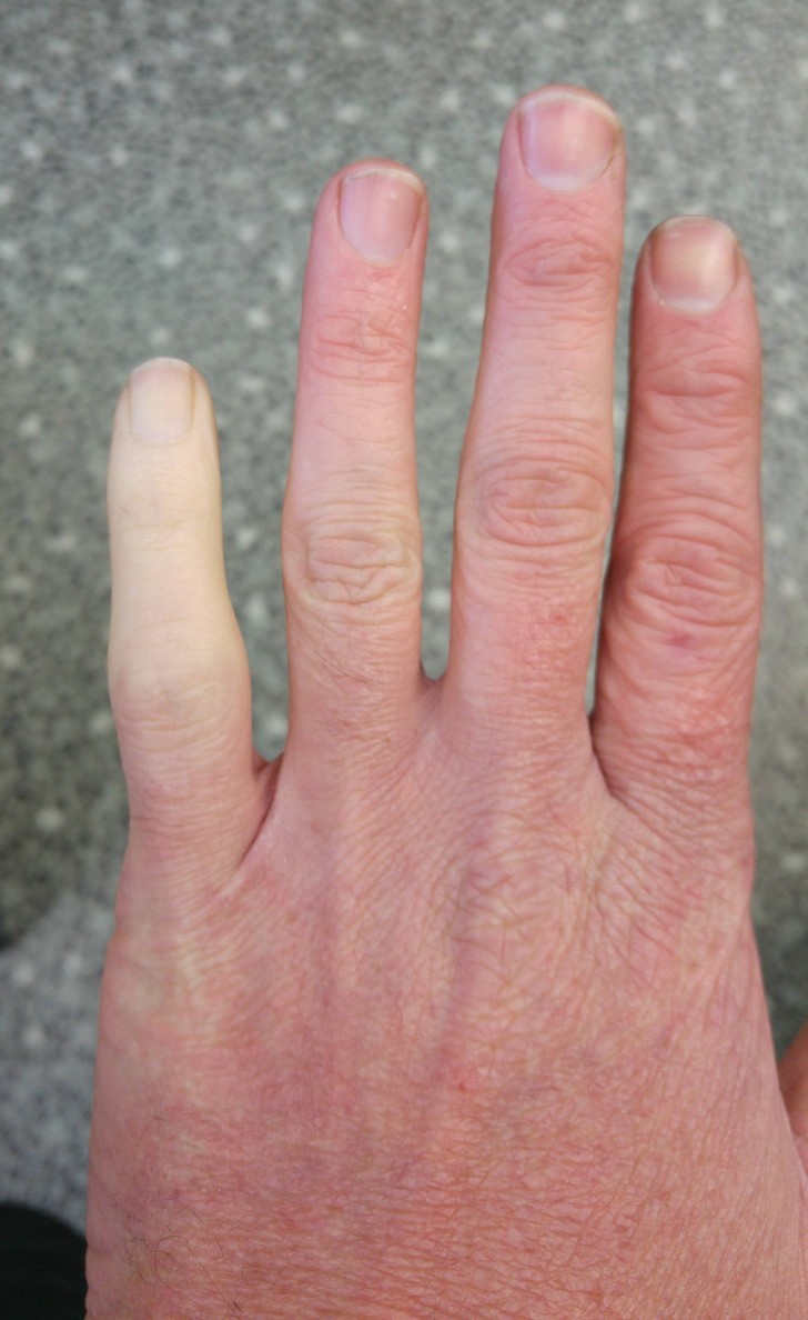 "18 miesięcy temu złamałem palec i od tego czasu staje się biały, gdy robi się zimno."