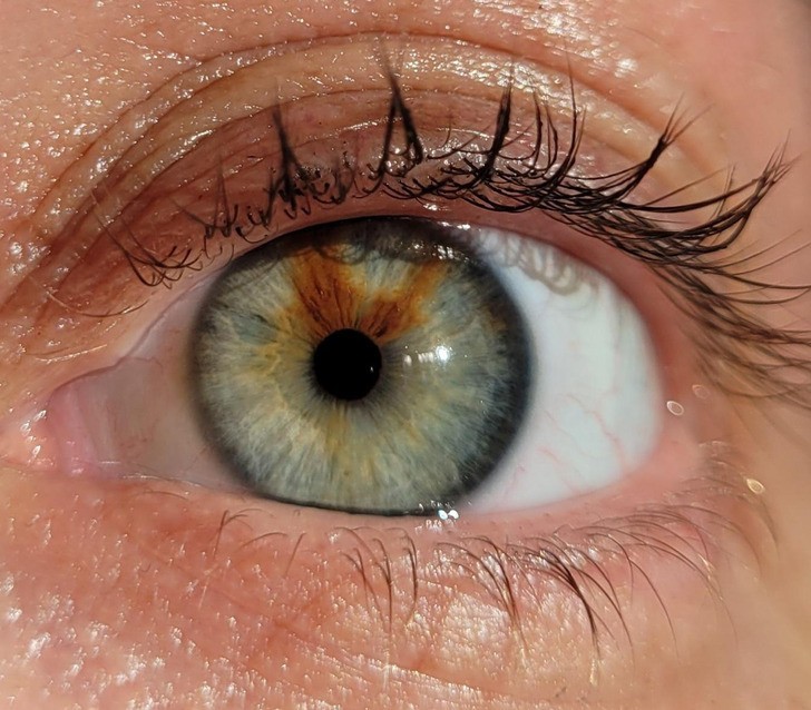 "Mam znamię w oku. Efekt częściowej różnobarwności tęczówek."