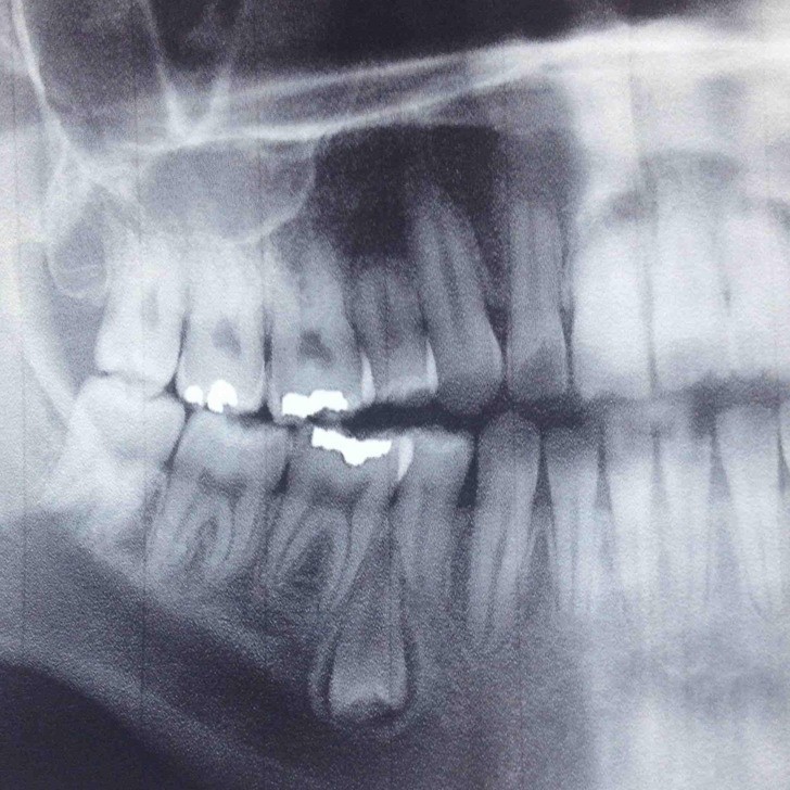 "Dentysta odkrył odwrócony ząb rosnący w moim dziąśle."