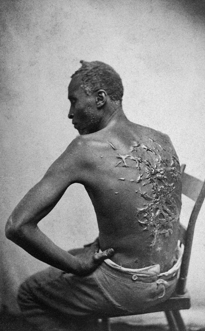 Zbiegły niewolnik, Peter, pokazujący swoje plecy poznaczone bliznami od bata