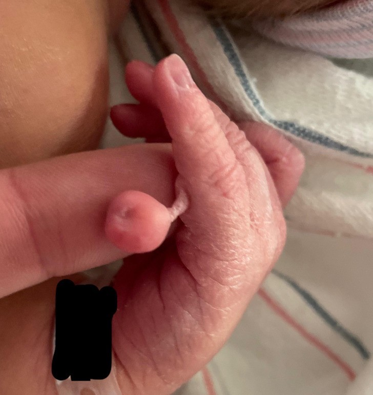 "Mój syn urodził się z dodatkowym palcem."