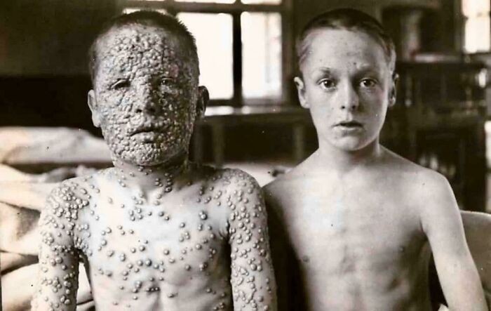Dwaj chłopcy wystawieni na działanie wirusa ospy. Jeden został szczepiony, drugi nie.