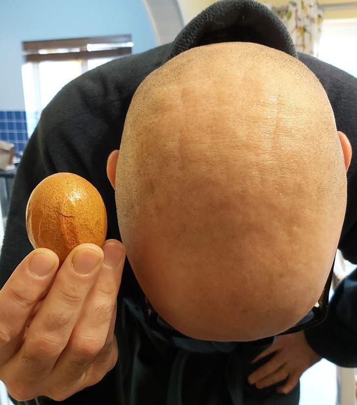 "To pomarszczone jajko pasuje do głowy mojego męża."