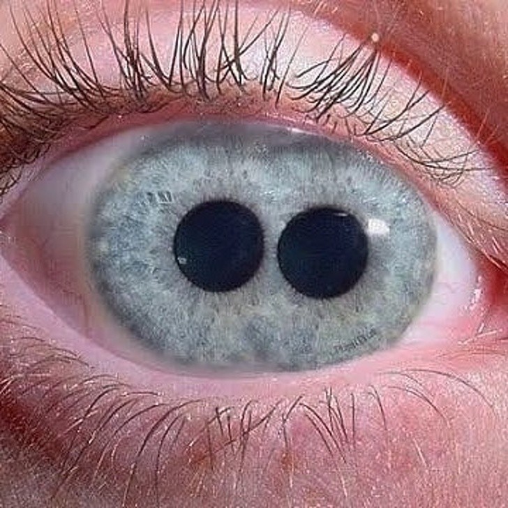 19. Przypadek policorii. Schorzenie, które powoduje, że w jednym oku wykształcają się dwie źrenice.