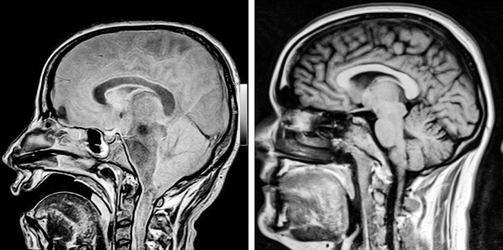 1. Mózg osoby w śpiączce w porównaniu do mózgu zdrowego człowieka