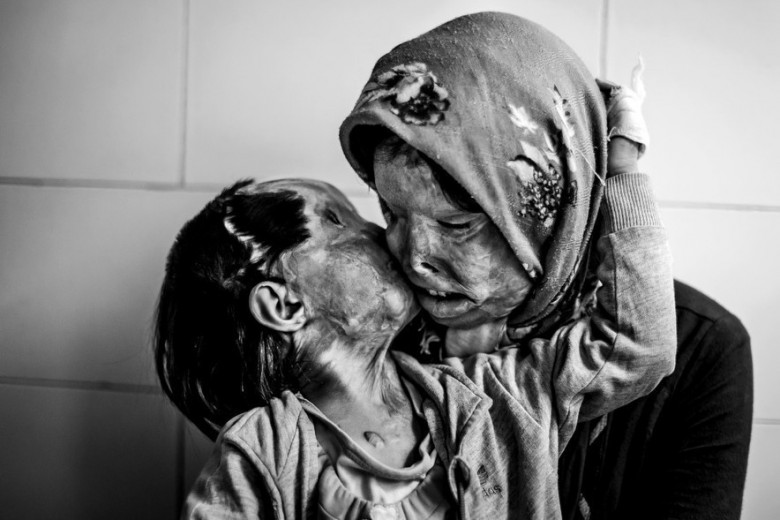 Matka i jej 3-letnia córka, które zostały oblane kwasem przez mężą/ojca