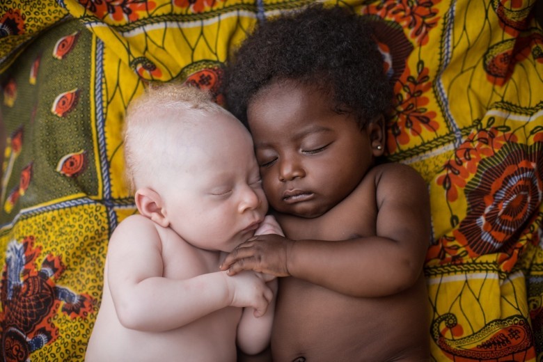 3-tygodniowy noworodek cierpiący na albinizm, śpiący obok swojego kuzyna. Kinshasa, Kongo