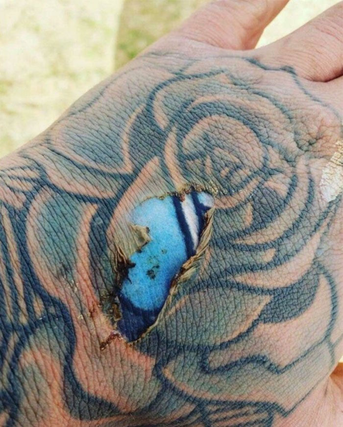 Gdy doznajesz oparzenia skóry w miejscu z wyblakłym tatuażem: