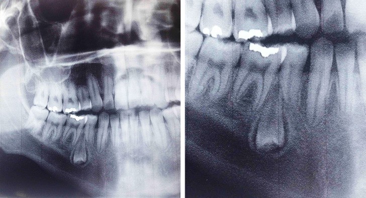 11. "Poszedłem wczoraj do dentysty i okazało się, że w moim dziąśle rośnie odwrócony ząb."