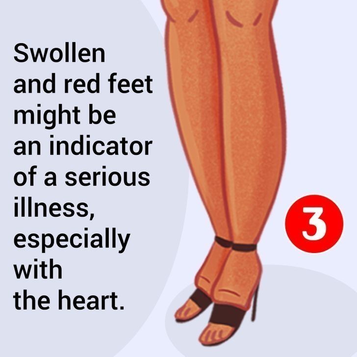 5. Spuchnięte i zaczerwienione stopy mogą być oznaką poważnych problemów z sercem.