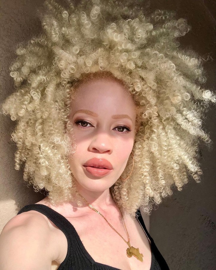 10. "Mój albinizm jest częścią mnie i jest piękny."