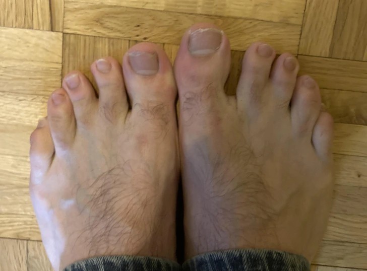 "Dwa palce u obu moich stóp są częściowo złączone."