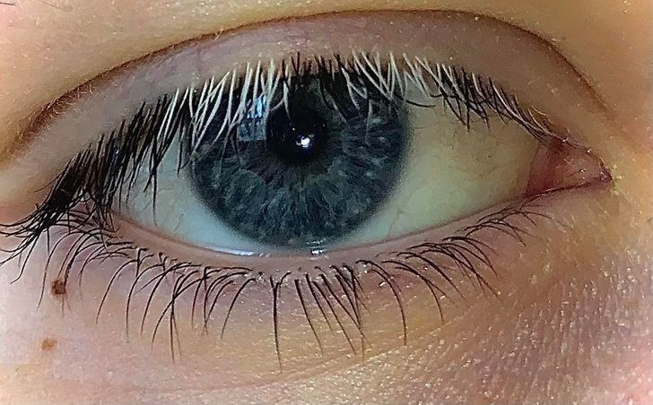 4. "Kilka miesięcy temu, rzęsy mojego prawego oka zrobiły się białe."