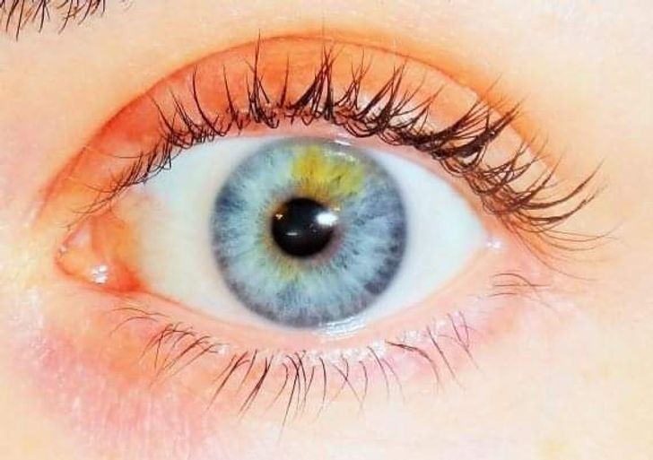 10. "Częściowa heterochromia. Uwielbiam moje lewe oko."