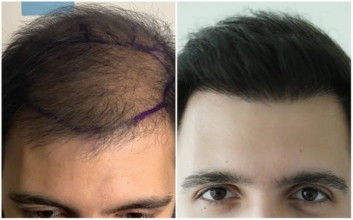 8. "Dla osób, które sądzą, że przeszczep włosów to mit: oto mój rezultat."